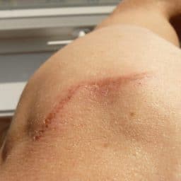 Close up of a scar on a person's shoulder
